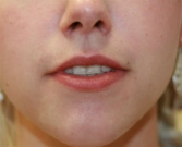 Feel Beautiful - Juvederm into lips - Before Photo